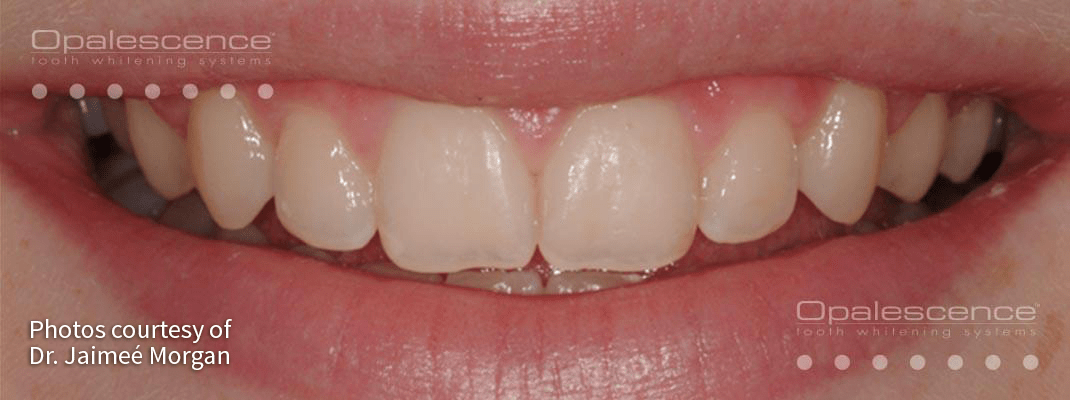 ก่อนระบบฟอกสีฟัน Opalescence